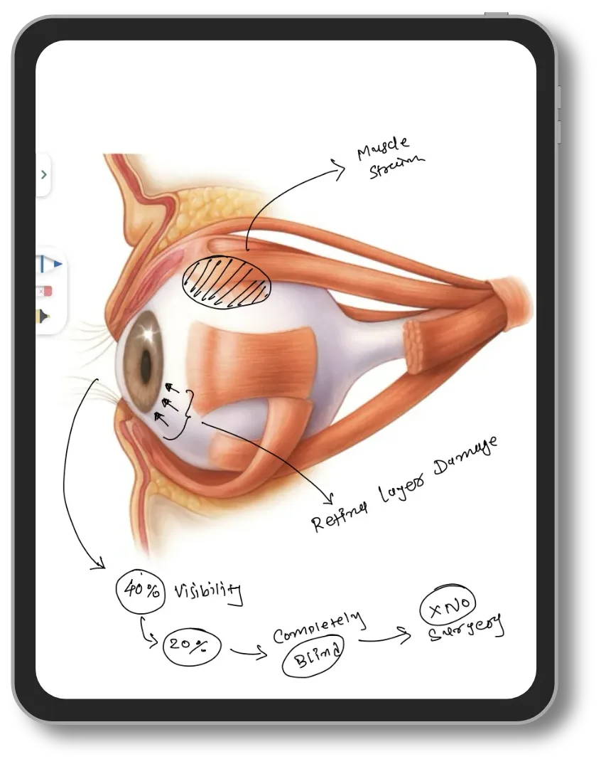 Doctor's notes drawn on an eye anatomy diagram in Lifemaan on a tablet