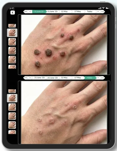 Lifemaan photo comparison: skin lesions on the back of a hand photographed at two visits, shown one above the other