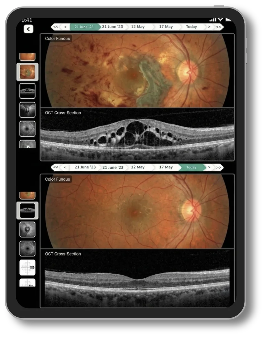 Lifemaan image comparison: colour fundus and OCT cross-section from two visits shown one above the other